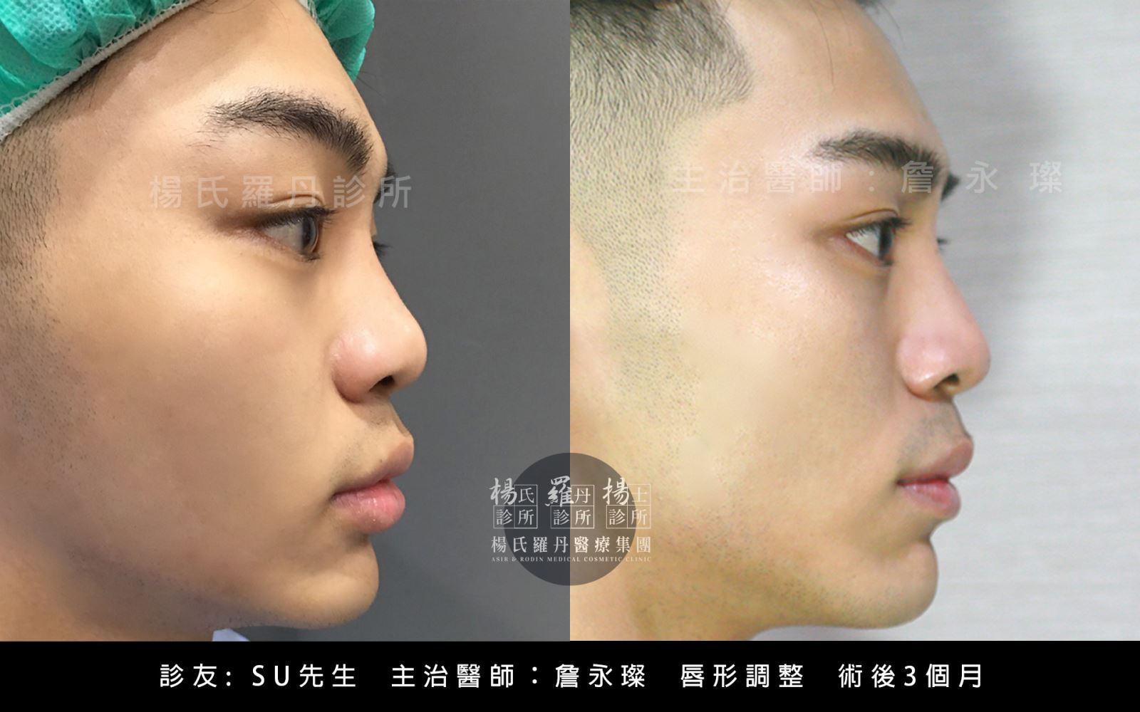 醫學美容  厚唇 挺鼻 楊氏羅丹 縮唇